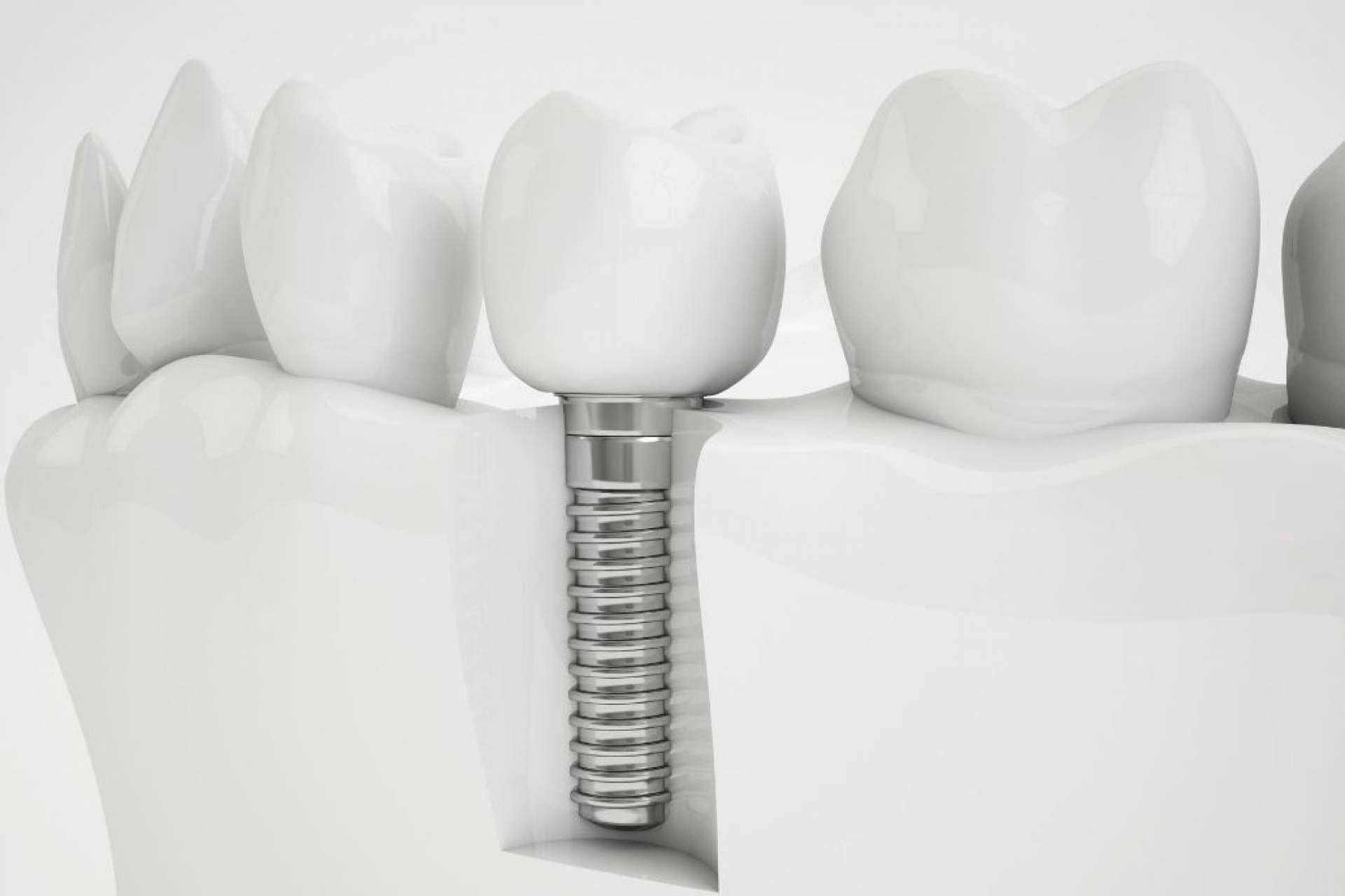 Grupo Gente Vital, especialista en implantes dentales