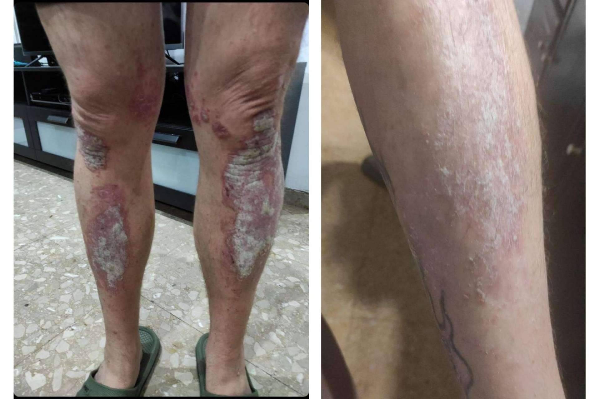 El antes y después de emplear la crema hidratante en pieles atópicas creada por Green Cornerss