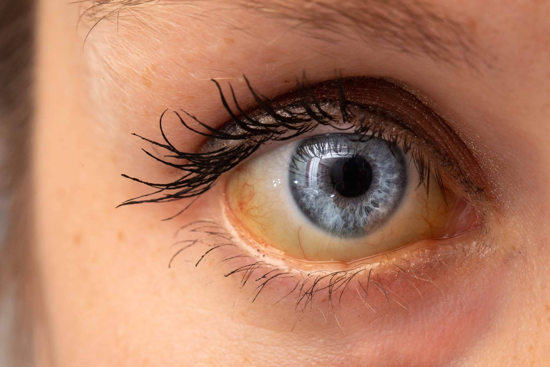 ¿A qué se deben los ojos amarillos y dónde tratarlos?, el Instituto Oftalmológico Dexeus lo explica