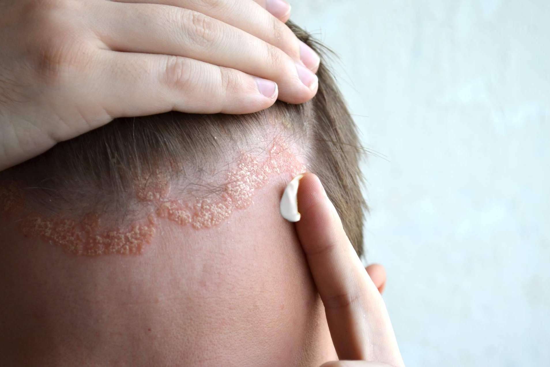 La Fundación Piel Sana de la AEDV resalta los riesgos que hay sobre la psoriasis en cuero cabelludo