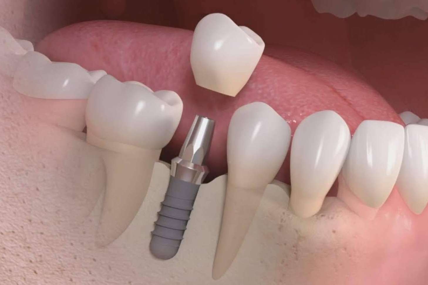 Toda la información necesaria sobre los implantes dentales de la Clínica Calvo de Mora