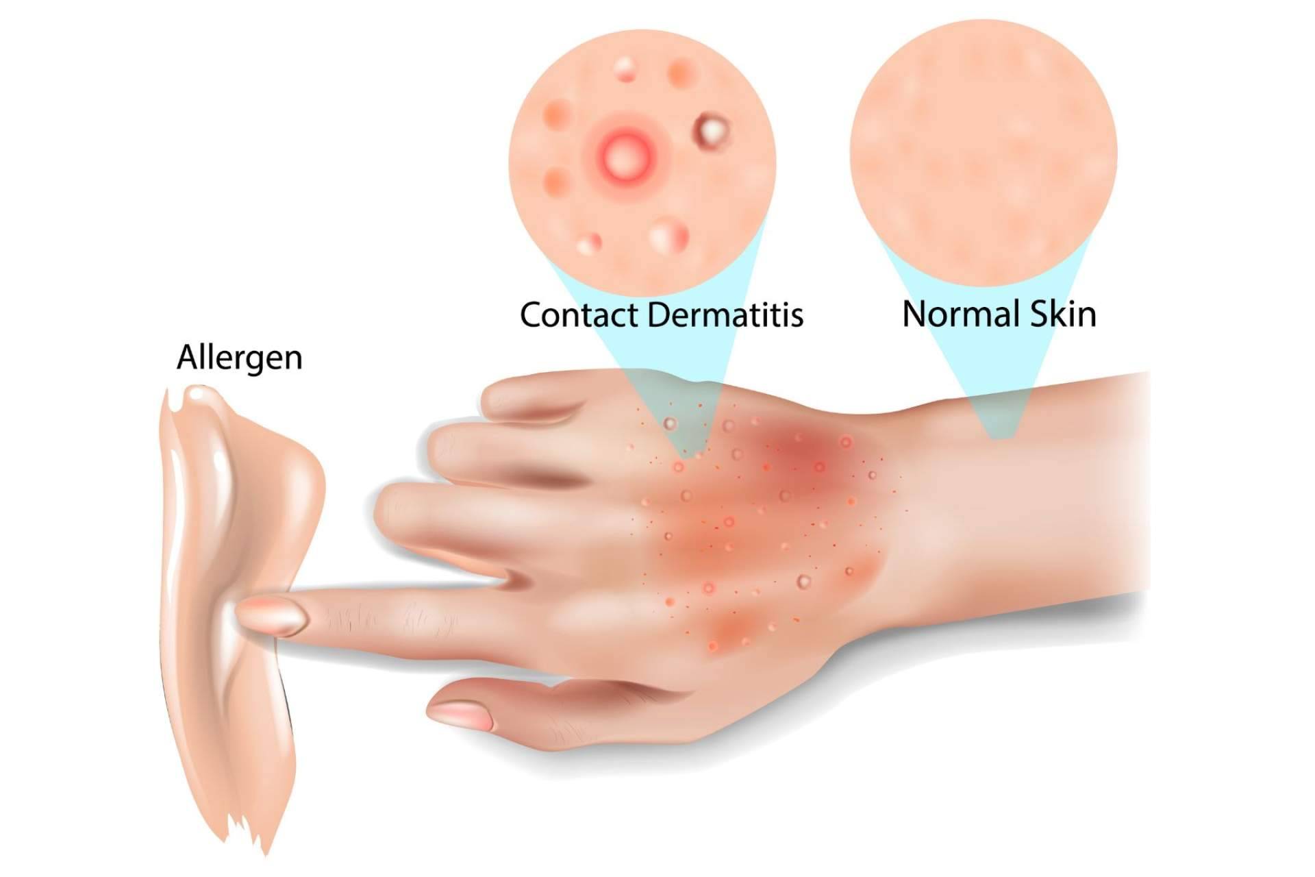 Una solución rápida y eficaz para la dermatitis, de la mano de eQuaid Pomada
