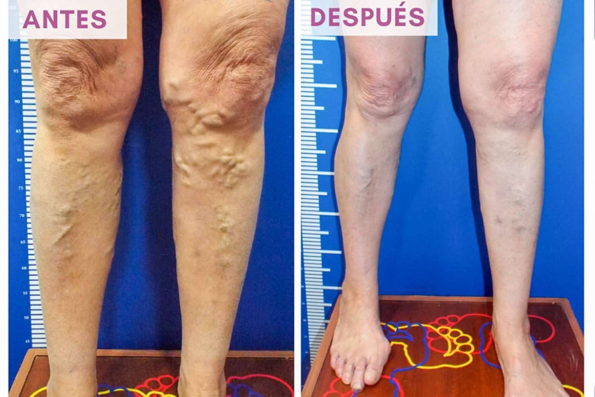 Eliminación de varices sin cirugía