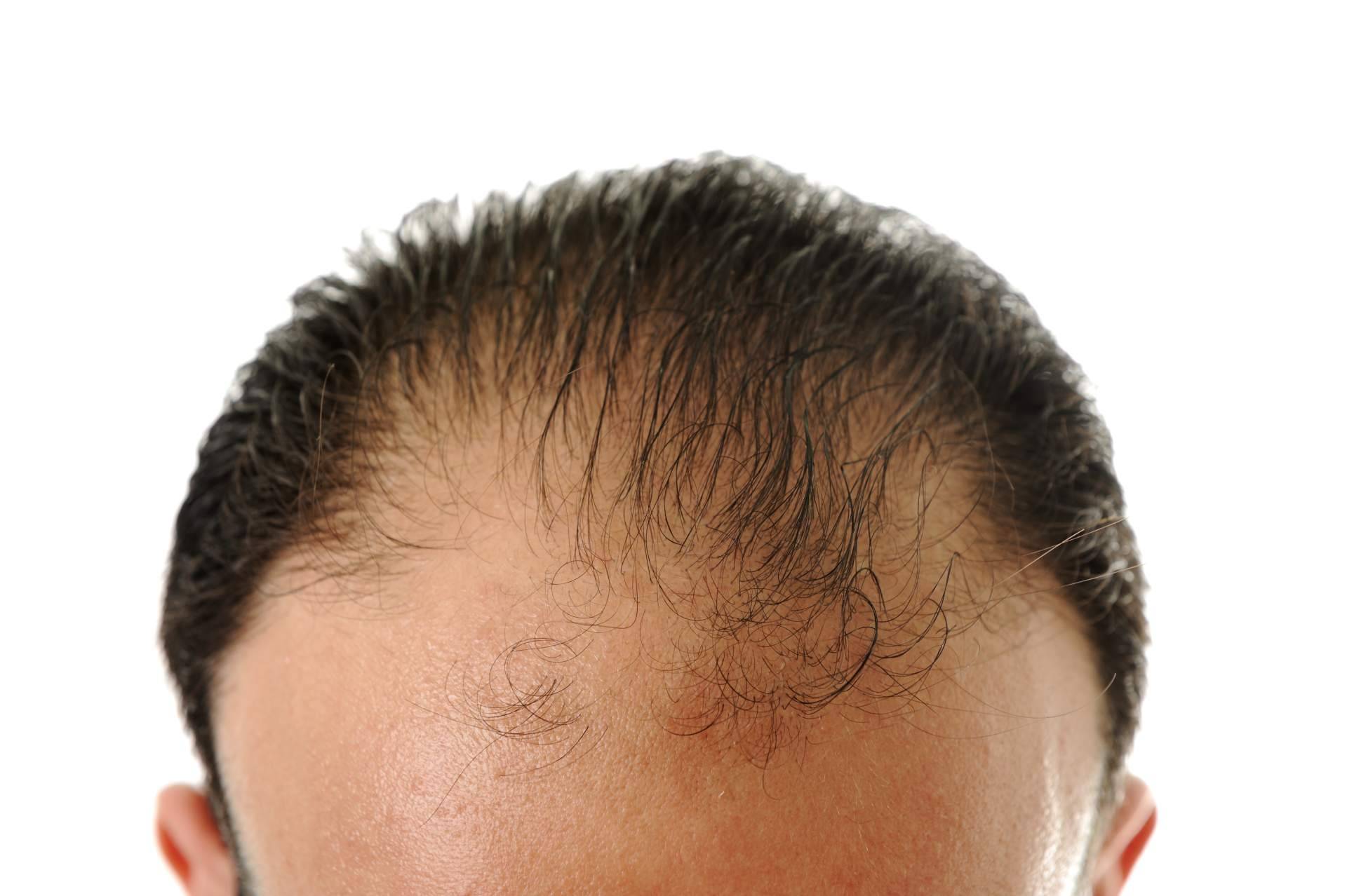Saw Palmetto ofrece una solución natural y efectiva para la caída del cabello