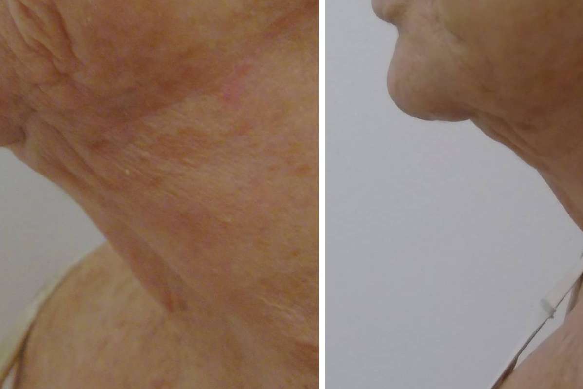 Dr. Tufet Madrid y Renophase especialistas en rejuvenecimiento del cuello