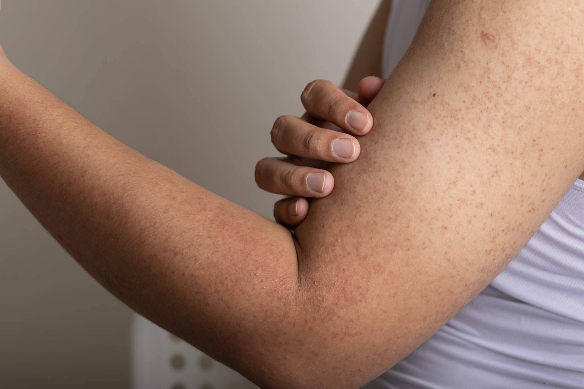 Consejos profesionales de la Dra. Janeth Arévalo para atenuar la queratosis pilaris