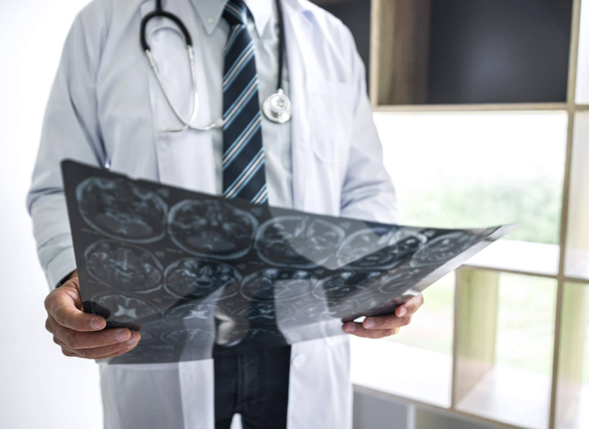 Inmunoterapia, tratar el alzheimer sin fármacos