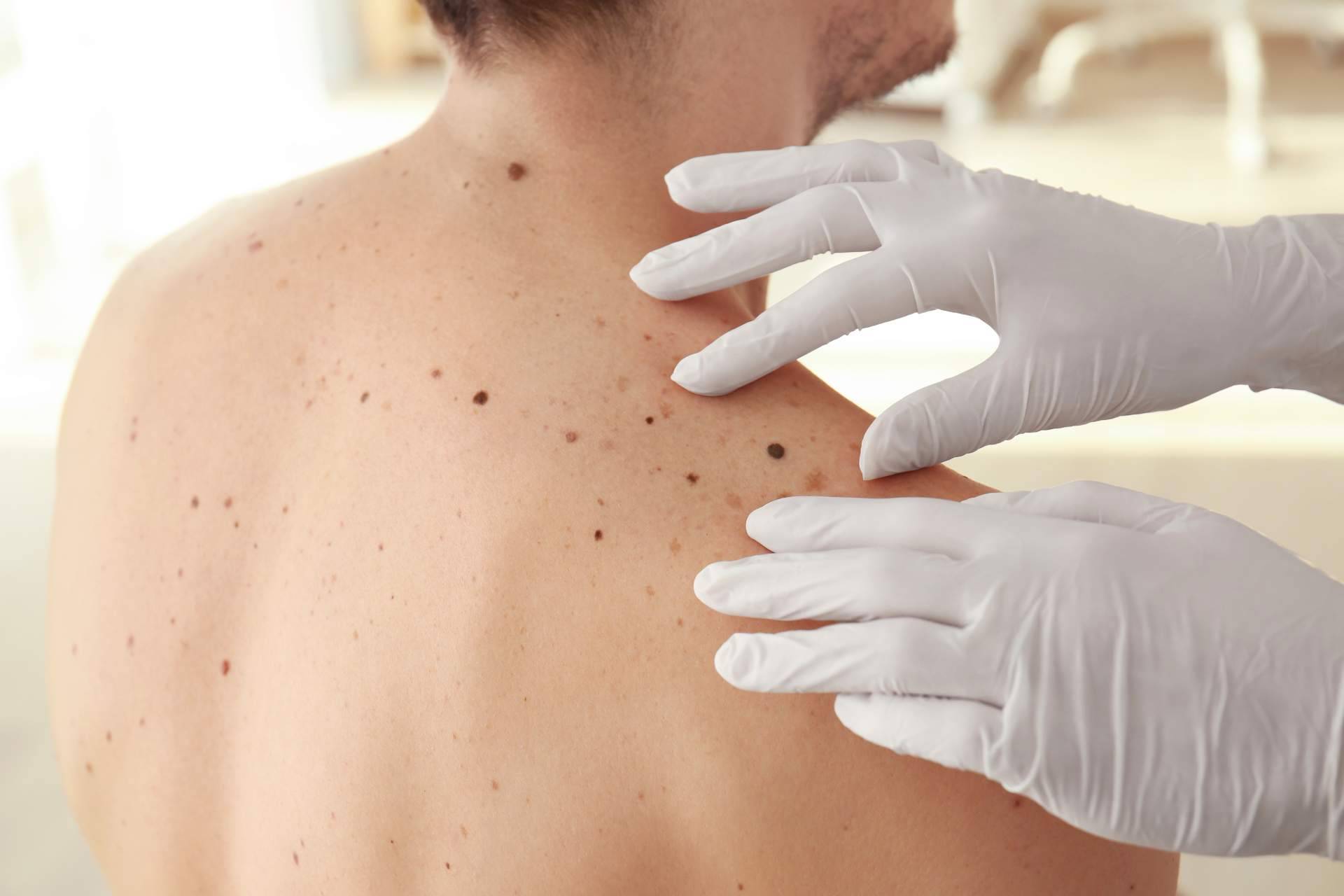 Eliminar las manchas en la piel, con los tratamientos del Centro Estética el Pilar