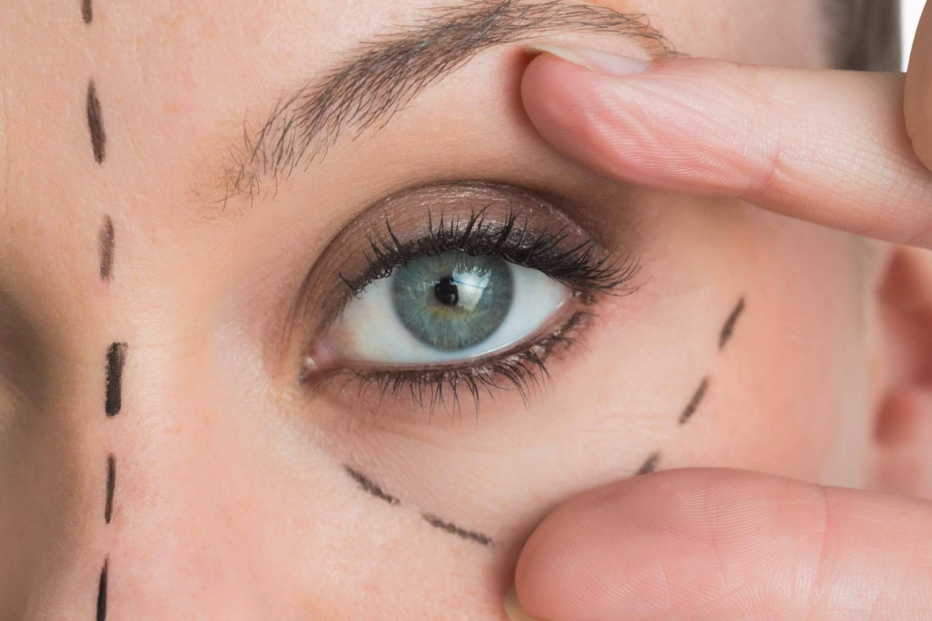 Rejuvenecer 10 años la mirada es posible con la blefaroplastia