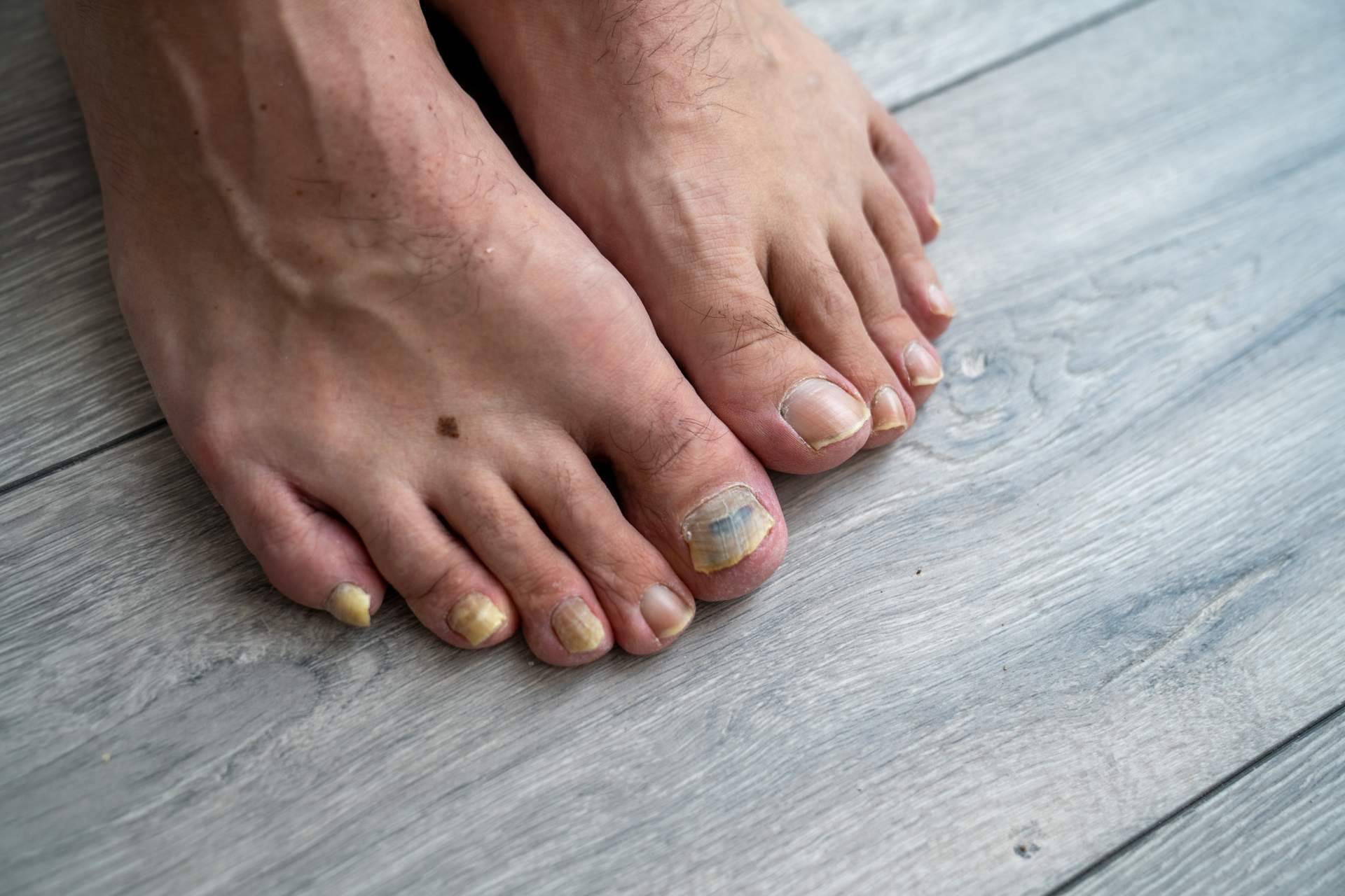 Prevenir las infecciones por hongos en verano, con el gel limpiador de Laboratoires Bailleul