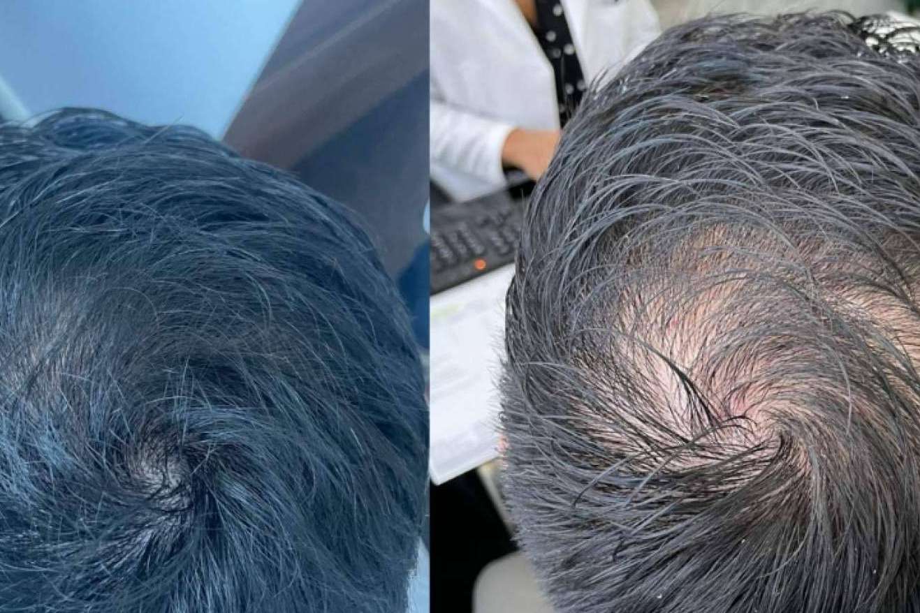 Detener la caída del cabello, con los tratamientos de medicina regenerativa de Immunotherapy Regenerative Medicine