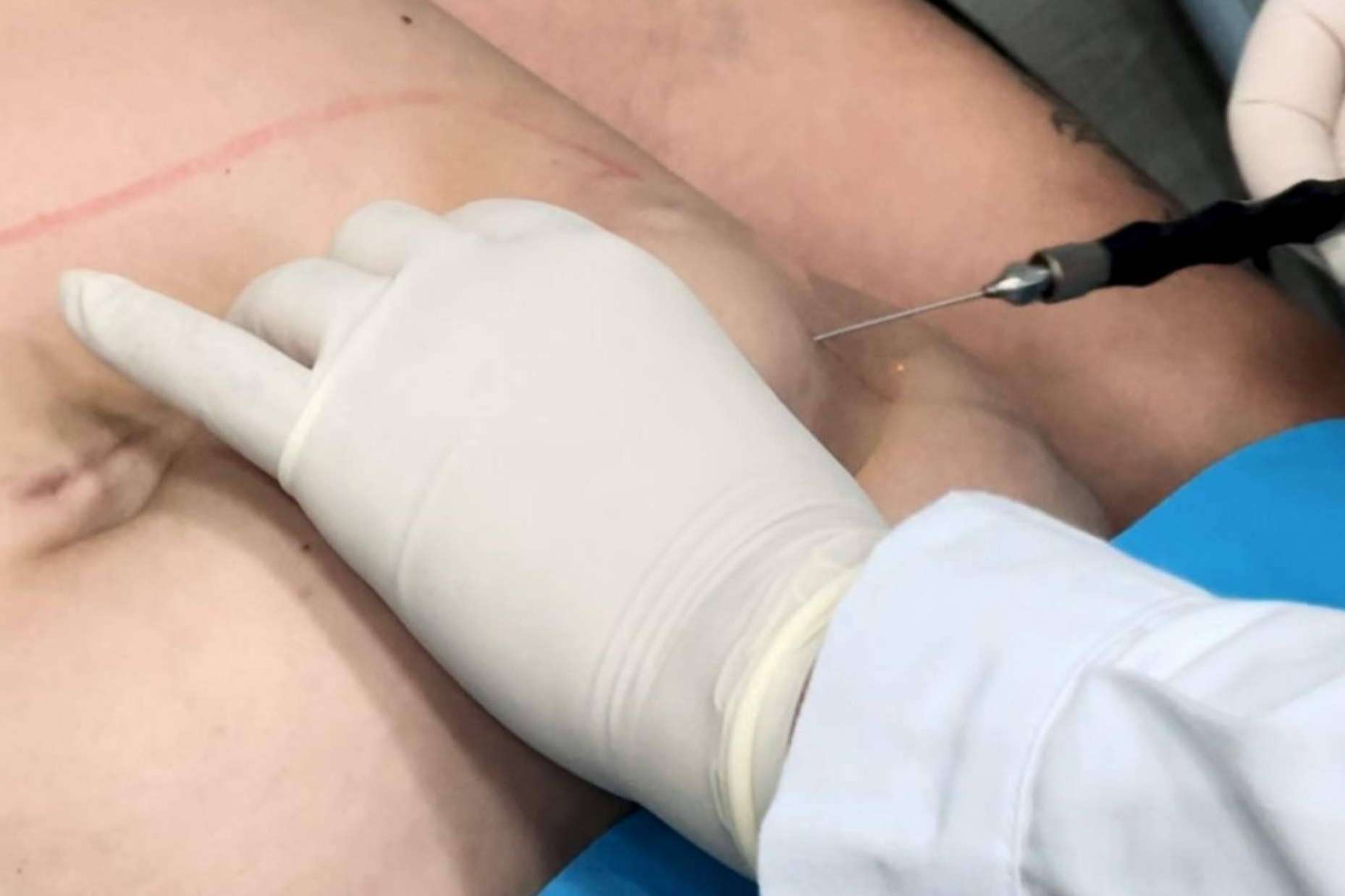 360Clinics lidera con Lipo Láserfit Medical, la revolución en tratamientos corporales sin cirugía