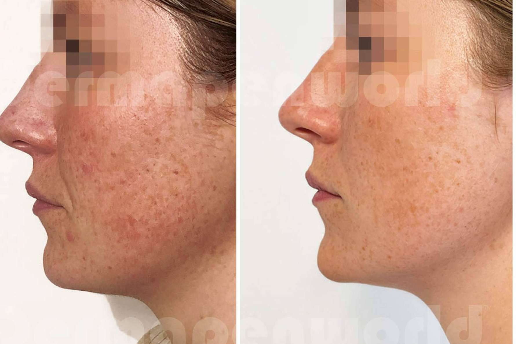 DERMAPEN™ de THR, es el microneedling médico estético por excelencia