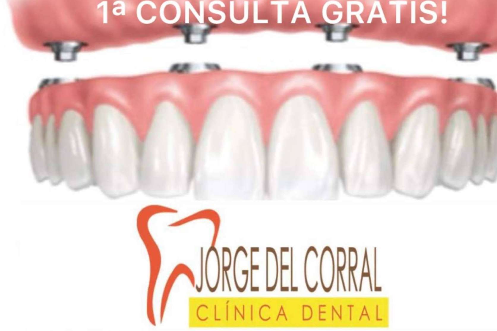 Madrid confía en Clínica Jorge del Corral para implantes dentales de excelencia