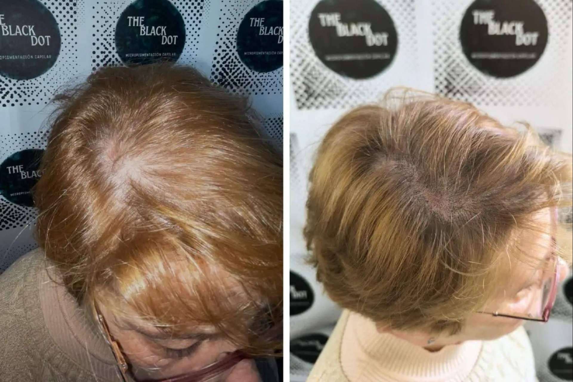 Mejorar la confianza con la Micropigmentación Capilar; Descubrir The Black Dot en Murcia
