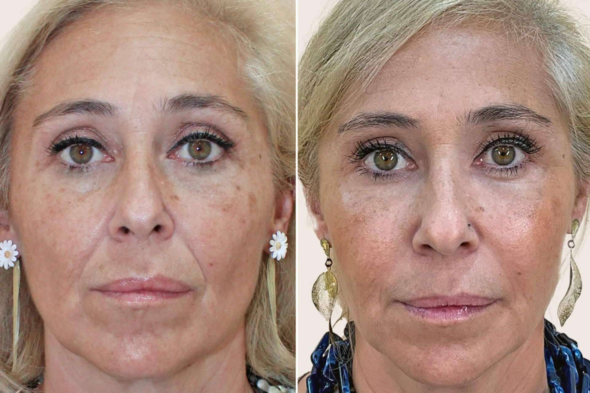 Armonización facial, el secreto 'celeb' para estar más guap@ a los 50 que a los 20