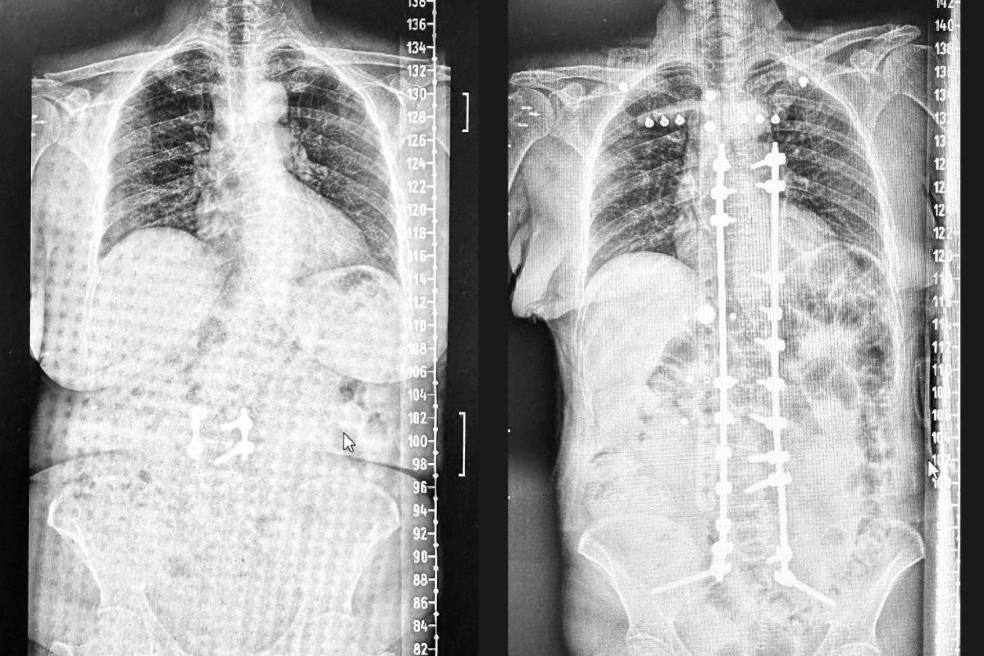La revolución 3D en la cirugía de escoliosis en el adulto; entrevista con el Dr. Carlos Botella-Asunción