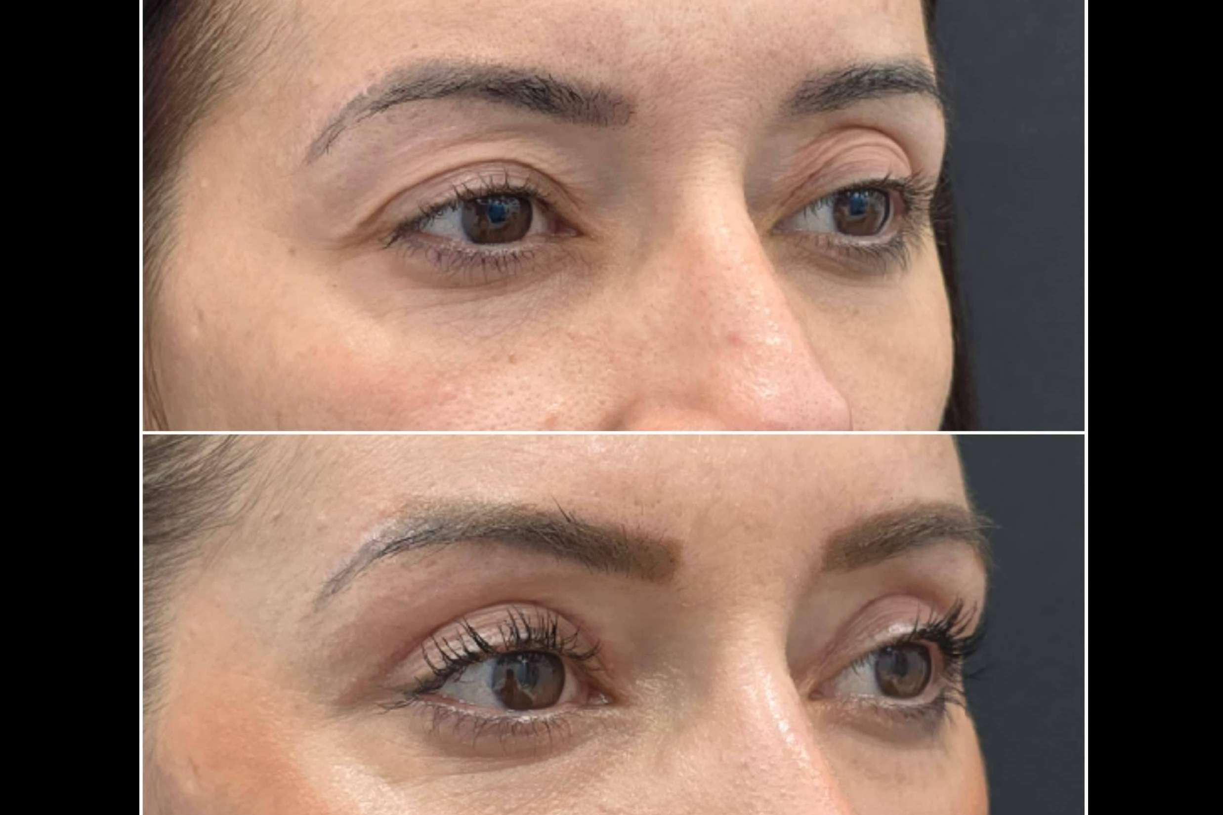 El exceso de piel en los párpados se elimina con EyeEvolution360, la blefaroplastia avanzada de 360Clinics