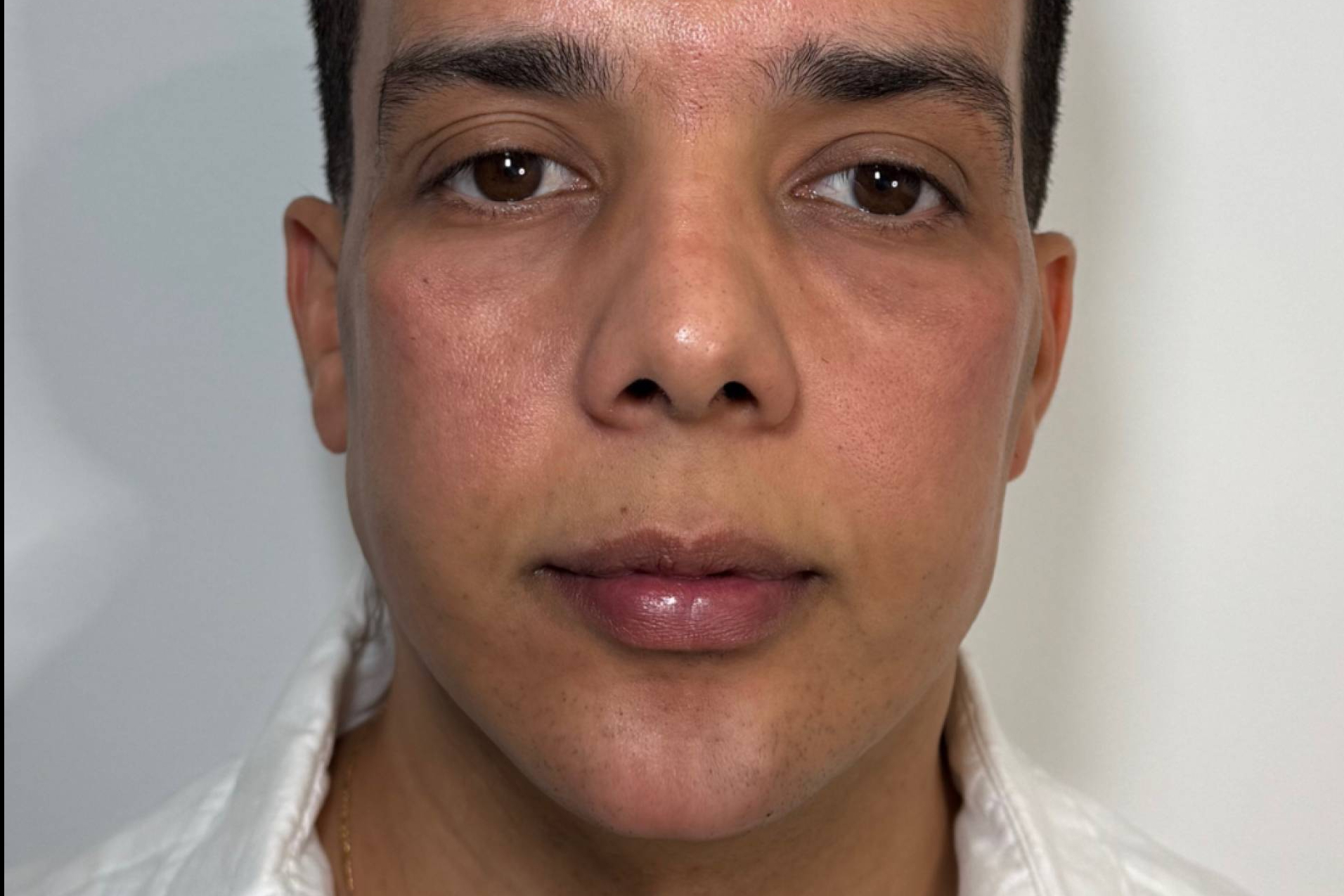 La Dra. Cecilia Arthur impulsa la masculinización facial con técnicas de medicina estética avanzada