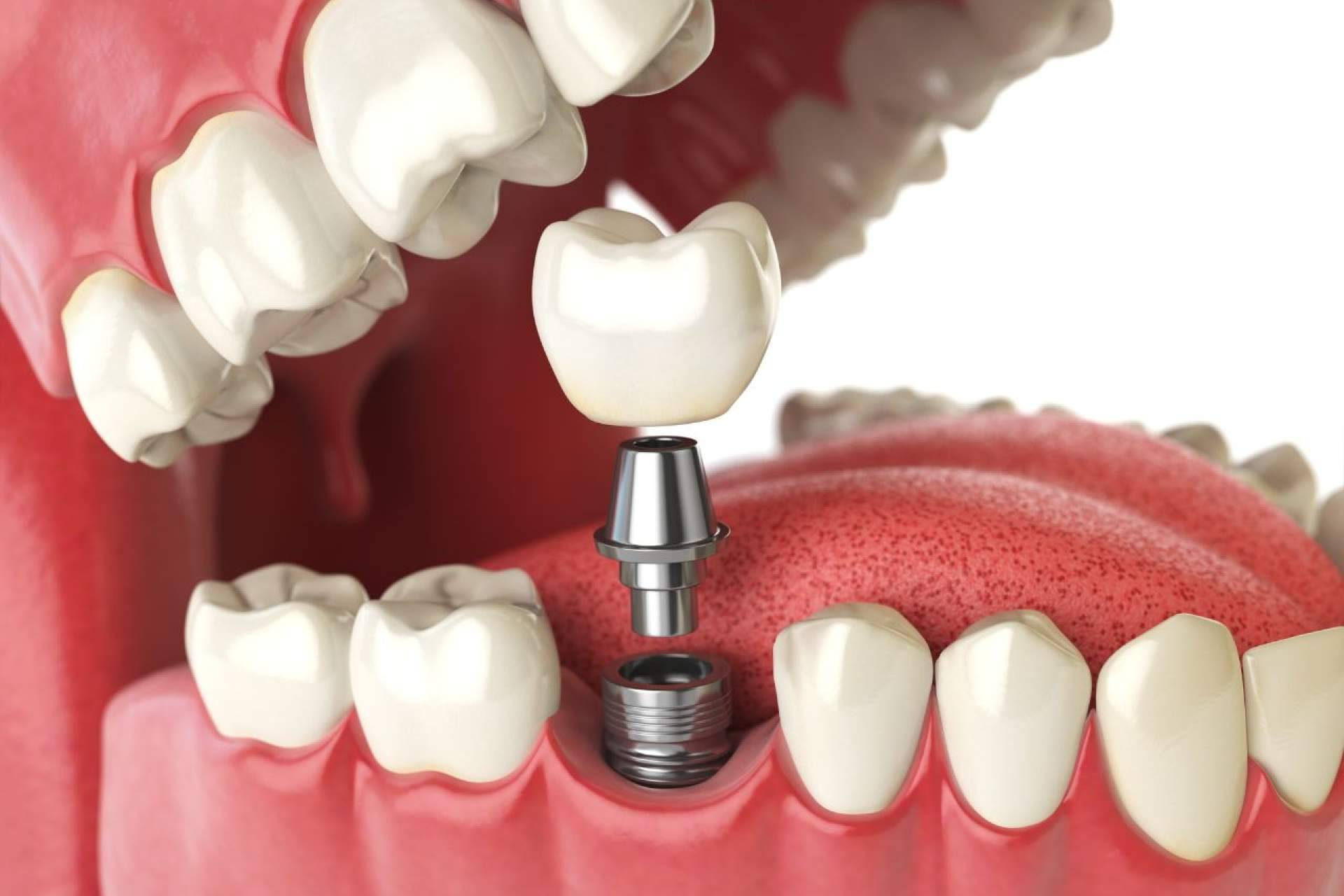 Cómo se coloca un implante dental en Málaga; Paso a paso sin dolor