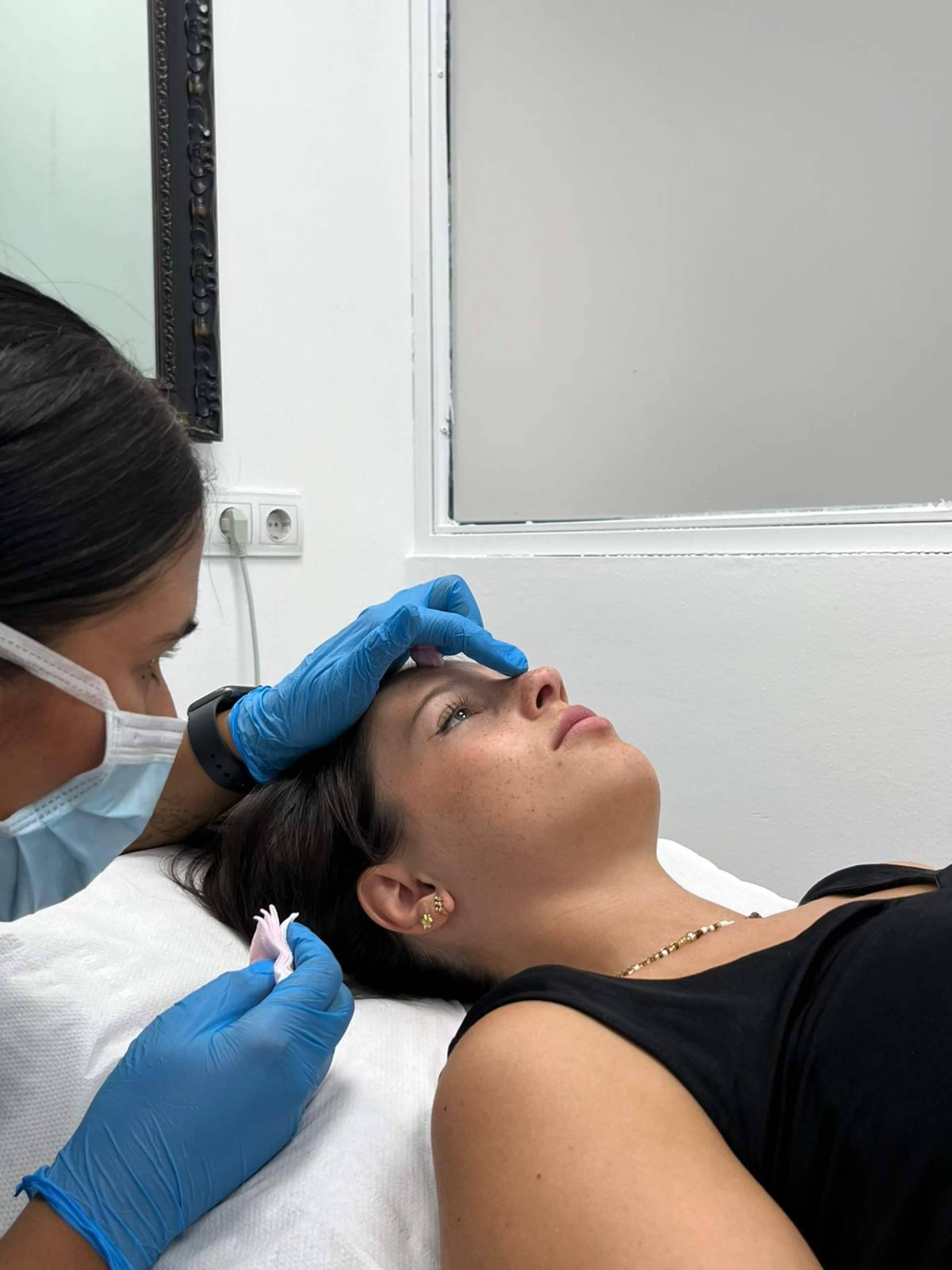 360Clinics explica cómo el ácido hialurónico ayuda a tratar el código de barras y rejuvenecer el labio superior