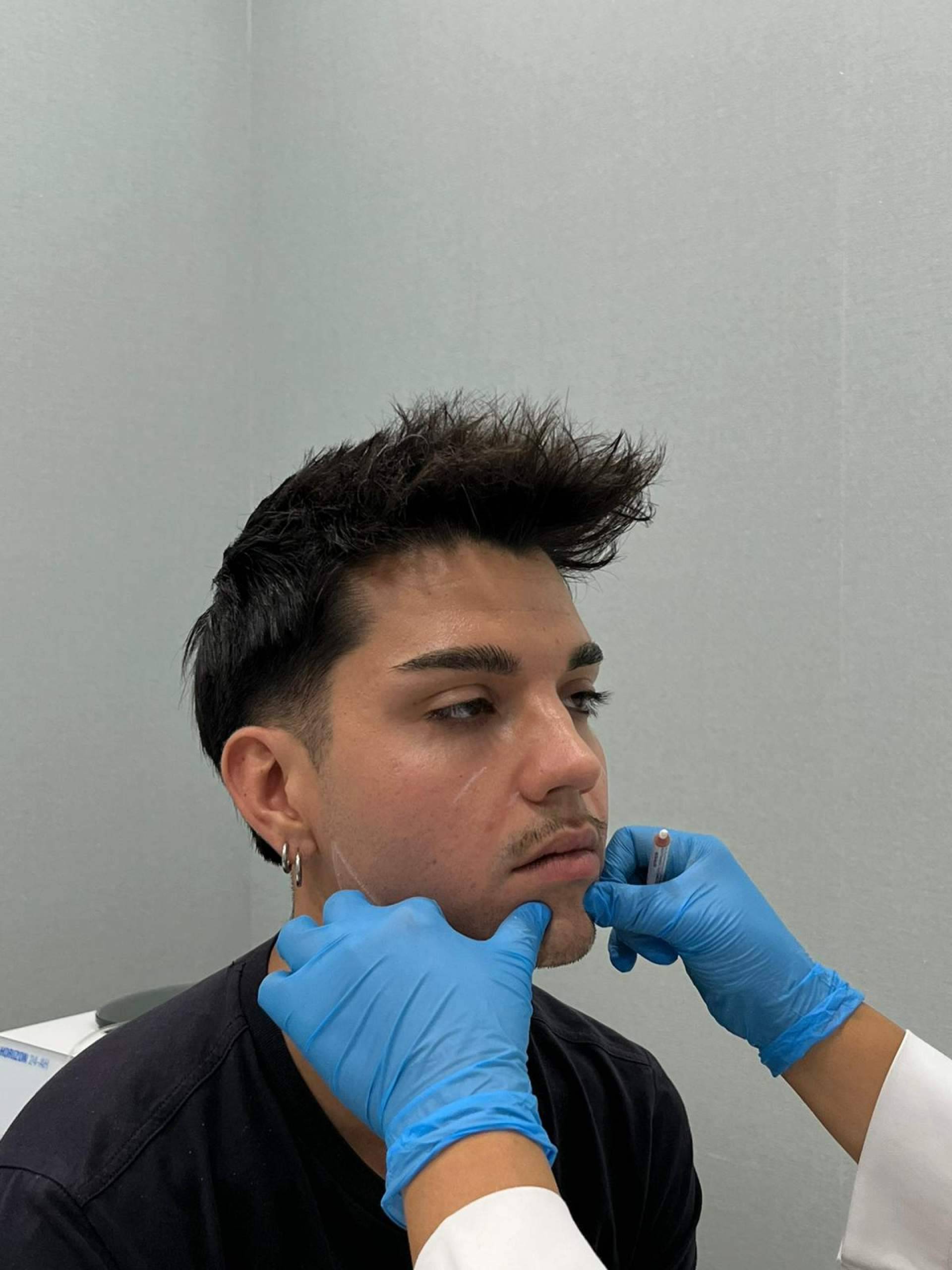 Rejuvenecimiento facial integral; la sinergia entre ácido hialurónico y tratamientos antiarrugas en medicina estética