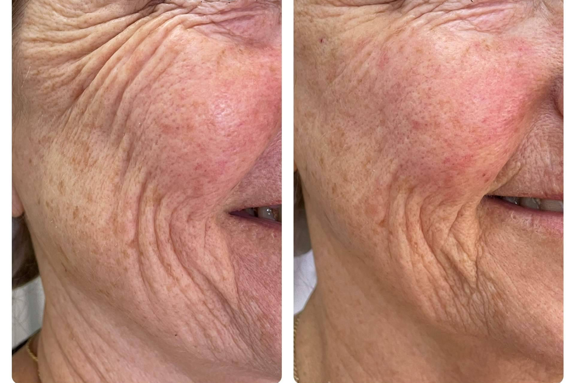 ¿Qué está impulsando la popularidad del lipofilling facial en 2026 frente al ácido hialurónico?
