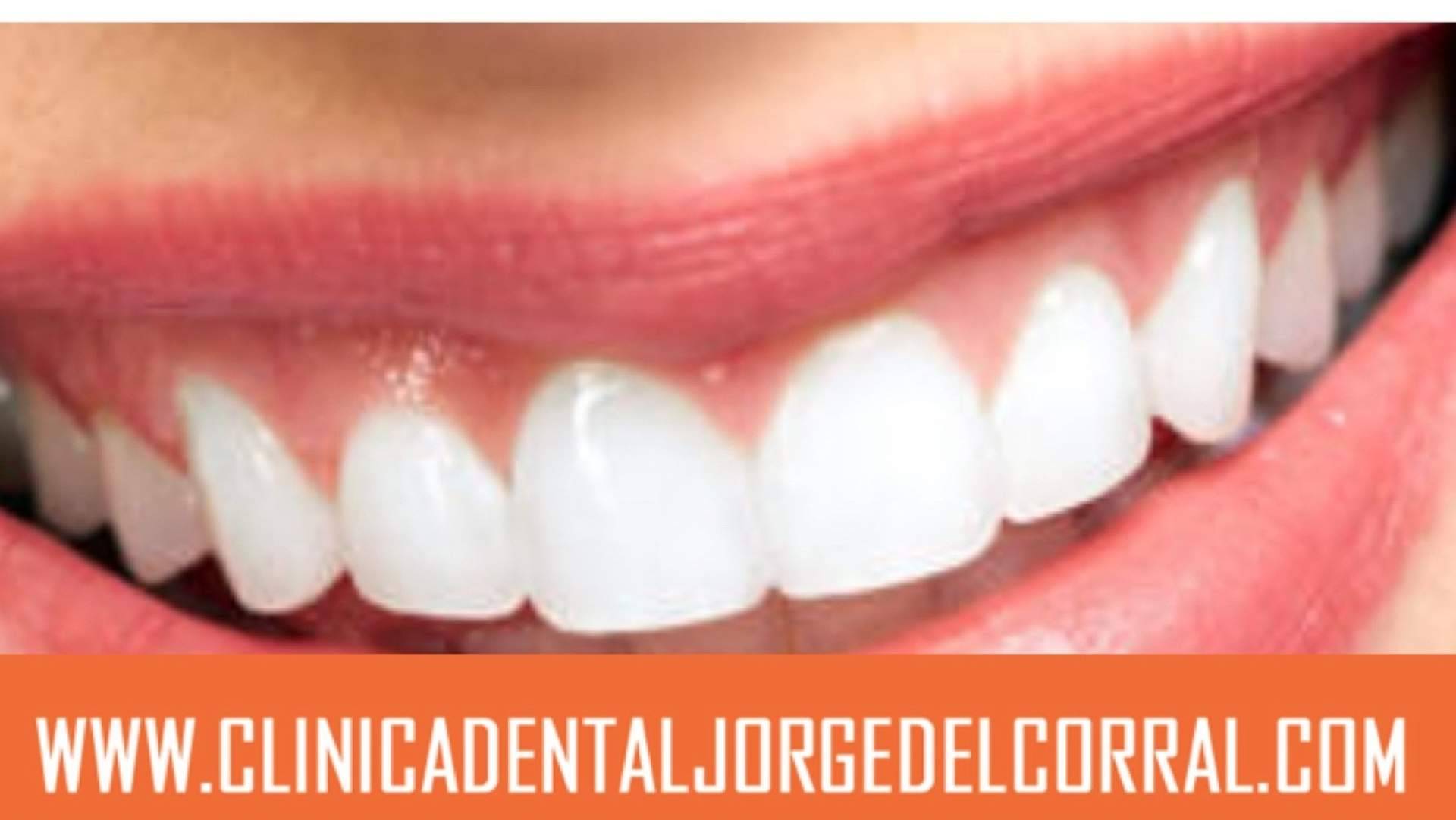 Clínica Dental Jorge del Corral impulsa la estética dental con carillas y prótesis fija de cerámica sin metal